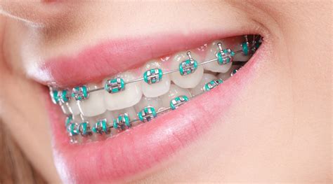 metal brackets orthodontics|metal braces with clear bands.